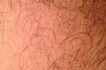 Itchy, Sore and Burn feeling in the Genital and Anal Area?
