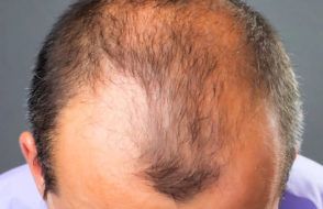 Home Remedies for Hair Loss and Feature Baldness