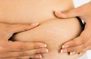 How to get rid of Stretch Marks after pregnancy?