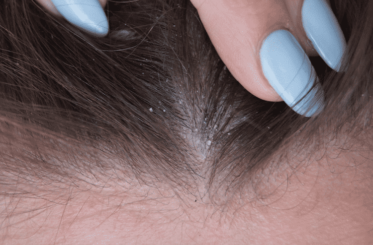 What Causes Dandruff And How To Treat It At Home