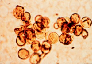 An insight into the Skin Disease - Chromoblastomycosis