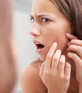 Tips for Combating Acne and keeping Blemishes in Bay
