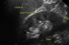 Lump in Testicle or Ache in Scrotum like 7 Symptoms Varicocele
