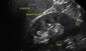 Lump in Testicle or Ache in Scrotum like 7 Symptoms Varicocele