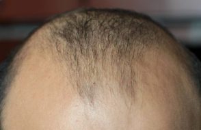 7 effective Ways to reduce Hair fall Fast and Naturally