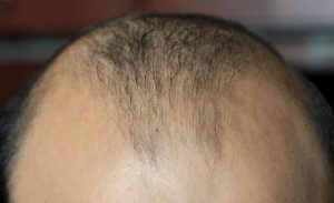 7 effective Ways to reduce Hair fall Fast and Naturally