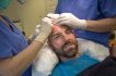 What makes Hair Transplant Natural?