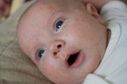Frequently Asked Questions (FAQ) related to Baby Acne Problems