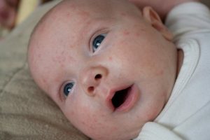 Frequently Asked Questions (FAQ) related to Baby Acne Problems