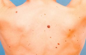Skin Cancer – How to Recognize and When to See a Doctor?