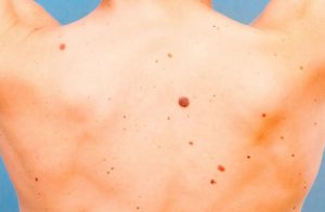 Skin Cancer – How to Recognize and When to See a Doctor?