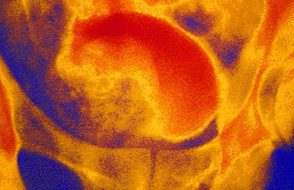 Prostate Enlargement Causes and Prevention