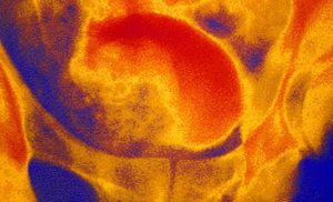 Prostate Enlargement Causes and Prevention