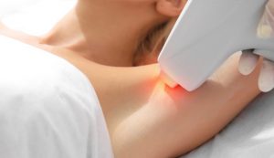 Differences between Laser Hair Removal and Intense Pulsed Light (IPL)