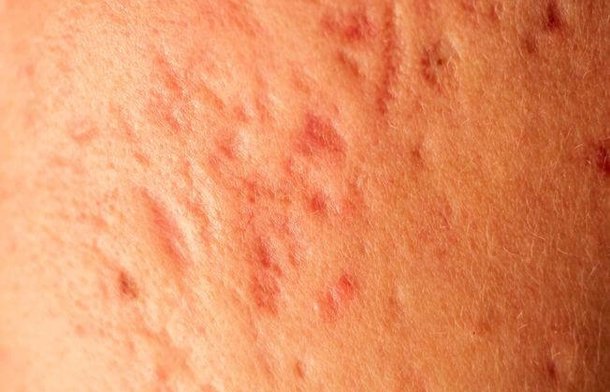 Acne Scar Removal – Why won’t they Fade Away?