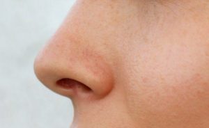 Things to know before your Septoplasty Surgery