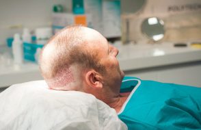 Methods for Hair Transplantation FUE, FUSS with Side effects