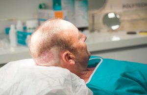 Methods for Hair Transplantation FUE, FUSS with Side effects