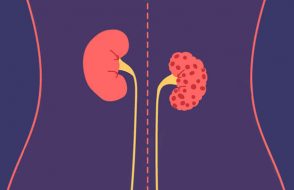 4 Ways to Support Renal Failure Patients - Keep your Kidneys Healthy