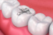 The Advantages and Disadvantages of Invisalign and Braces