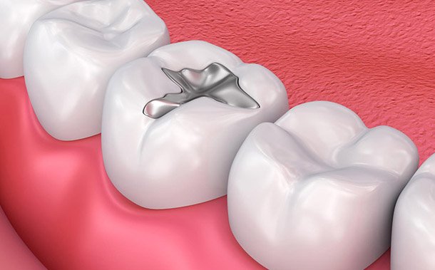 The Advantages and Disadvantages of Invisalign and Braces