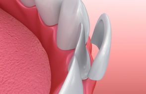What are Composite Veneers and How it restore a damaged tooth?