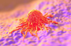 Tumor Cancer Surgery - Preparing for the Procedure