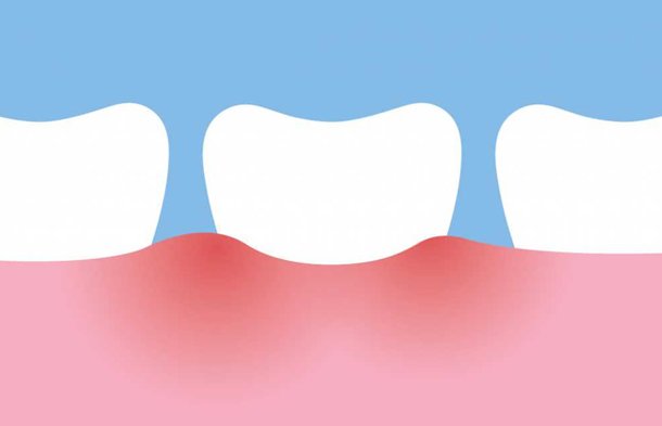 5 Dental Care Tips for dealing with Sensitive Teeths
