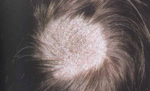 A Guide to Fue Hair Transplant and its Benefits?