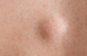 Lipoma Medical Conditions and its excision Method