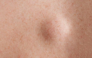 Lipoma Medical Conditions and its excision Method