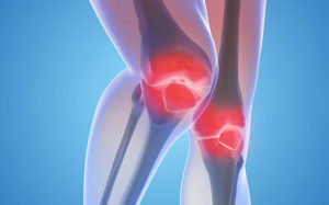 What are the Natural Therapies for Arthritis Pain?