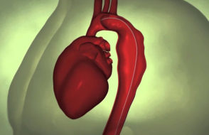 Bentall Procedure - Who are the fellow actually needs them?