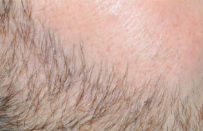 6 Tips to Help you make an informed decision on Beard Transplants