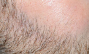 6 Tips to Help you make an informed decision on Beard Transplants