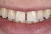 Diastema - Understanding the Causes of Gap in Front Teeth