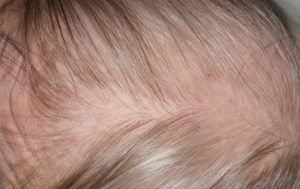 Everything you need to know about Hair Transplant Aftercare and Recovery