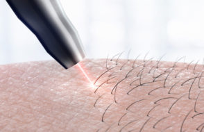 Some Important Pros and Cons of Laser Hair Removal