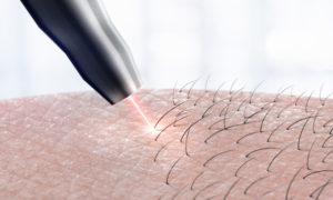 Some Important Pros and Cons of Laser Hair Removal