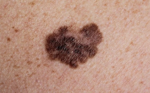 A Deep Dive into the Roundup Cancer Cases and Settlements