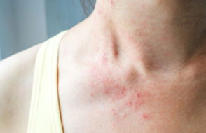 8 Causes of Skin Rashes in Women- Symptoms & Remedies