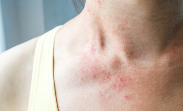 8 Causes of Skin Rashes in Women- Symptoms & Remedies