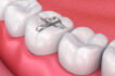 Composite Bonding for filling Fractures, Gaps between your Teeth