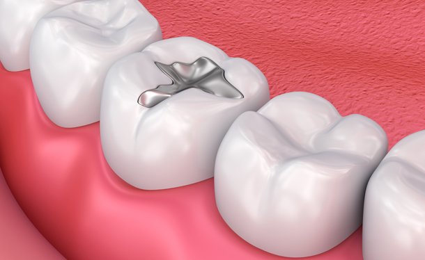 Composite Bonding for filling Fractures, Gaps between your Teeth