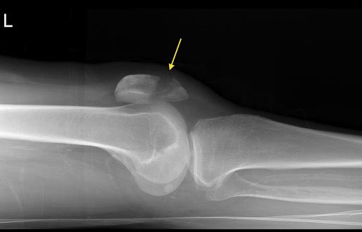 Understanding Transverse Fracture - Causes and Diagnosis