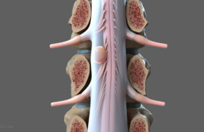 What is Spinal Stenosis of the Lumbar Region?