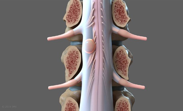 What is Spinal Stenosis of the Lumbar Region?