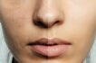 Why Peels for Pigmentation Work?