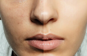 Why Peels for Pigmentation Work?