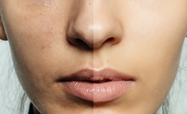 Why Peels for Pigmentation Work?